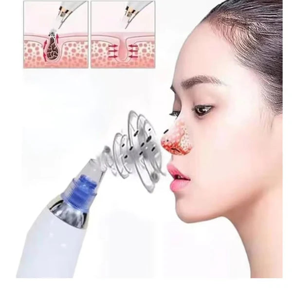 4 In 1 Blackhead Whitehead Extractor Remover Device Acne Pimple Pore Cleaner (Vacuum Suction Tool)